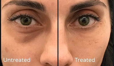 High Frequency for Under-Eye Bags: The Non-Surgical Fix That Actually Works